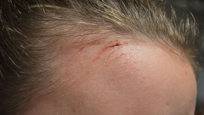 Det blev även skrubbsår i pannan. Foto: Privat