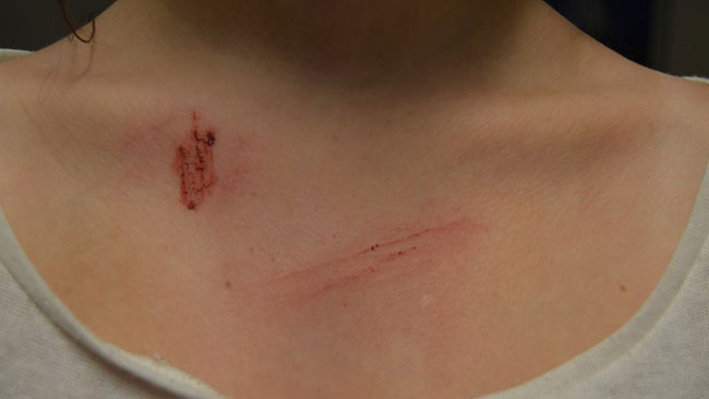 Även här har 13-åringen fått märken. Foto: Privat