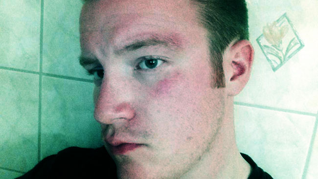 Knytnävsslaget träffade både ögonbrynet och strax under ögat. Foto: Privat