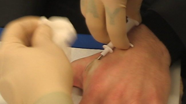 Här opereras ett elektroniskt RFID-chip in under huden på en Stockholmare. Foto: Jakob Bergman / Nyheter Idag